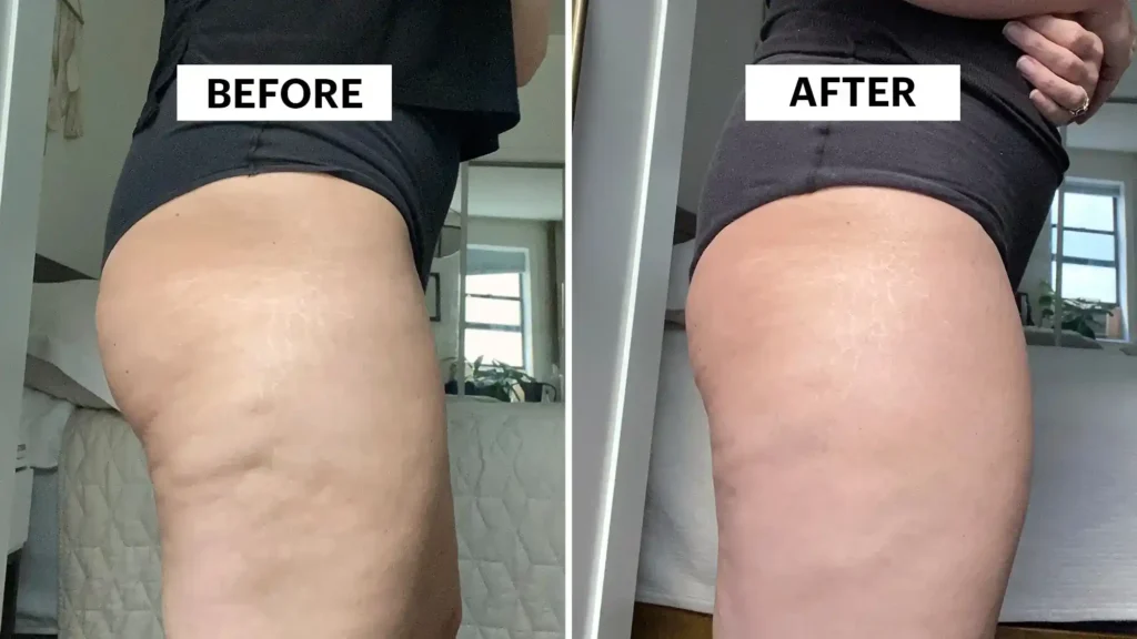 Do Toning Exercise Brentwood Really Tackle Cellulite?