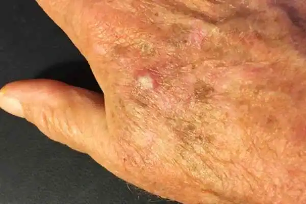 Image of Actinic keratoses Brentwood on a person hand