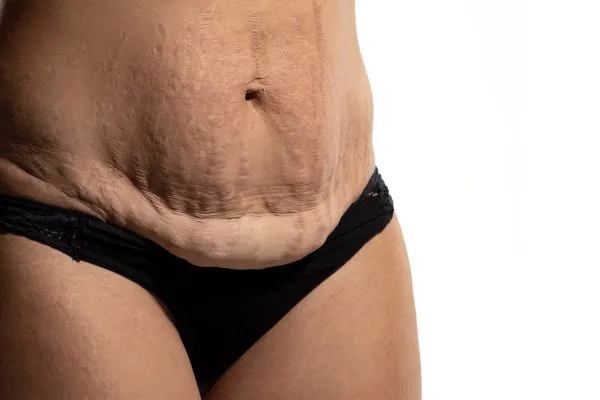 The science behind skin tightening Brentwood picture of a woman's sagging skin on the stomach